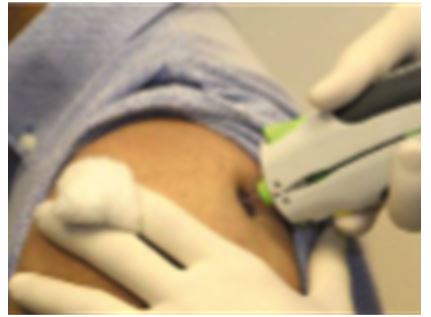 Needle-free Injection – Eradicating Diseases to Improve Global Health